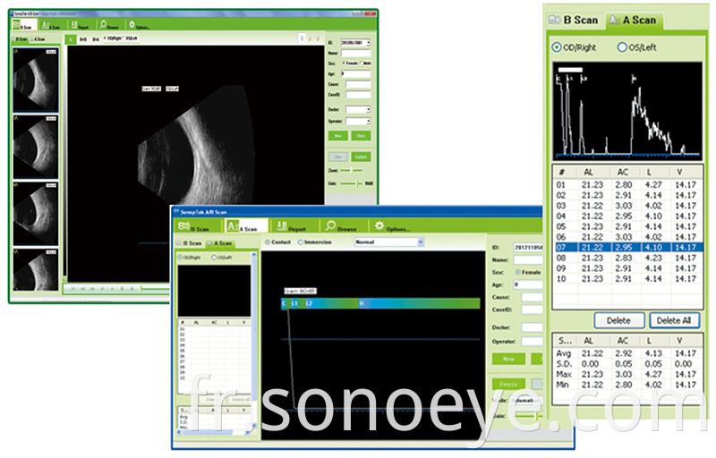 Ophthalmic A/B Scanner